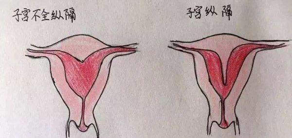 纵隔子宫影响试管婴儿