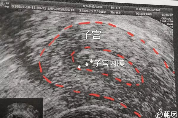 B超可检查子宫内膜厚度