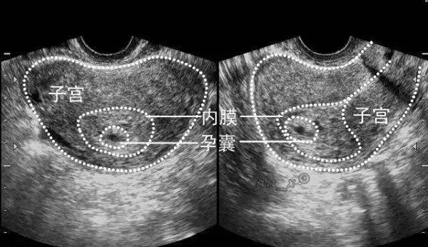 试管也会出现空囊