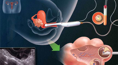 胚胎移植流程图